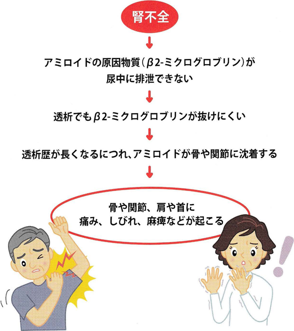 透析アミロイド症