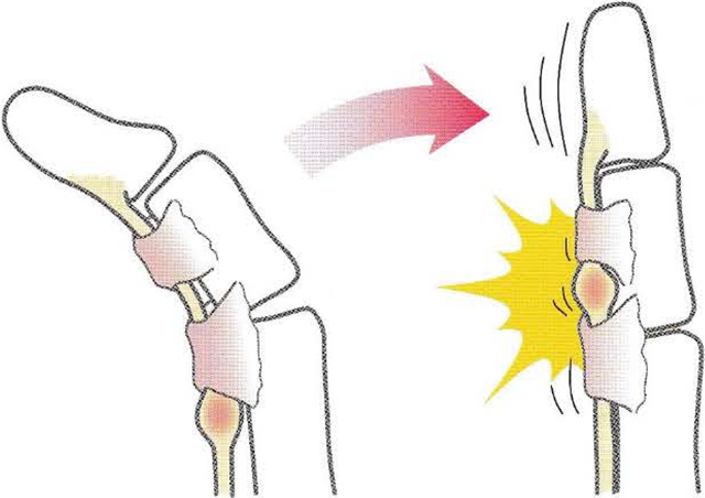 弾発指(バネ指)