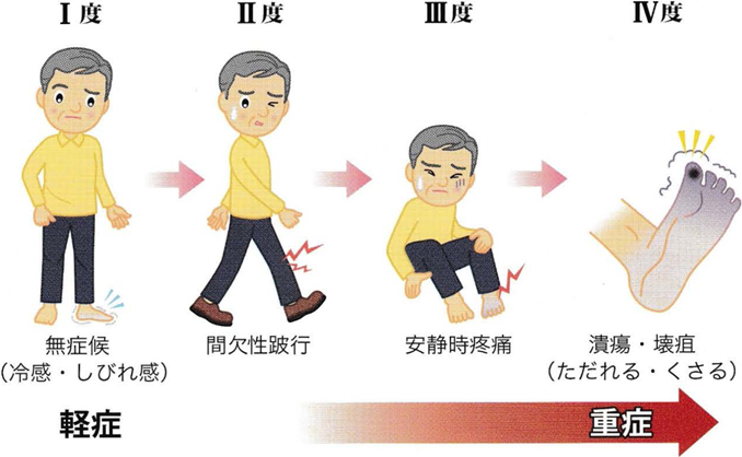 末梢動脈疾患(PAD)