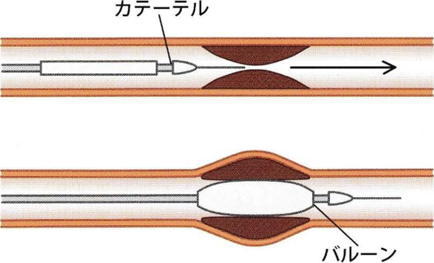 カテーテル治療